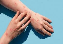 କେରଳରେ ପୁଣି ମଙ୍କିପକ୍ସ ଆତଙ୍କ