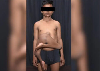 ଦିଲ୍ଲୀ ଏମ୍ସରେ ବିରଳ ଅସ୍ତ୍ରୋପଚାର, ବିଶ୍ୱରେ ସର୍ବମୋଟ୍ ୪୨ତମ ଘଟଣା: ନାବାଳକ ଠାରୁ ଅଲଗା ହେଲା ପାରାସାଇଟିକ୍ ଟ୍ୱିନ୍‌