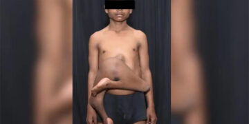 ଦିଲ୍ଲୀ ଏମ୍ସରେ ବିରଳ ଅସ୍ତ୍ରୋପଚାର, ବିଶ୍ୱରେ ସର୍ବମୋଟ୍ ୪୨ତମ ଘଟଣା: ନାବାଳକ ଠାରୁ ଅଲଗା ହେଲା ପାରାସାଇଟିକ୍ ଟ୍ୱିନ୍‌