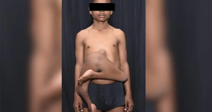 ଦିଲ୍ଲୀ ଏମ୍ସରେ ବିରଳ ଅସ୍ତ୍ରୋପଚାର, ବିଶ୍ୱରେ ସର୍ବମୋଟ୍ ୪୨ତମ ଘଟଣା: ନାବାଳକ ଠାରୁ ଅଲଗା ହେଲା ପାରାସାଇଟିକ୍ ଟ୍ୱିନ୍‌